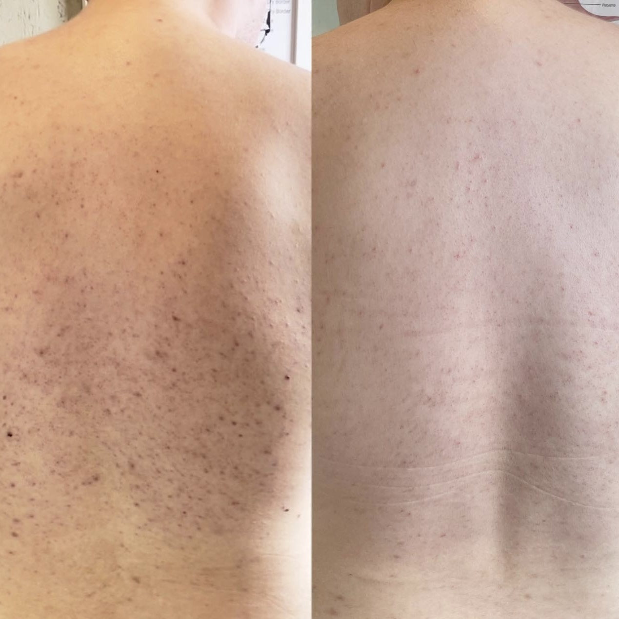 Acne Spray │ Get Rid Of Acne In Weeks