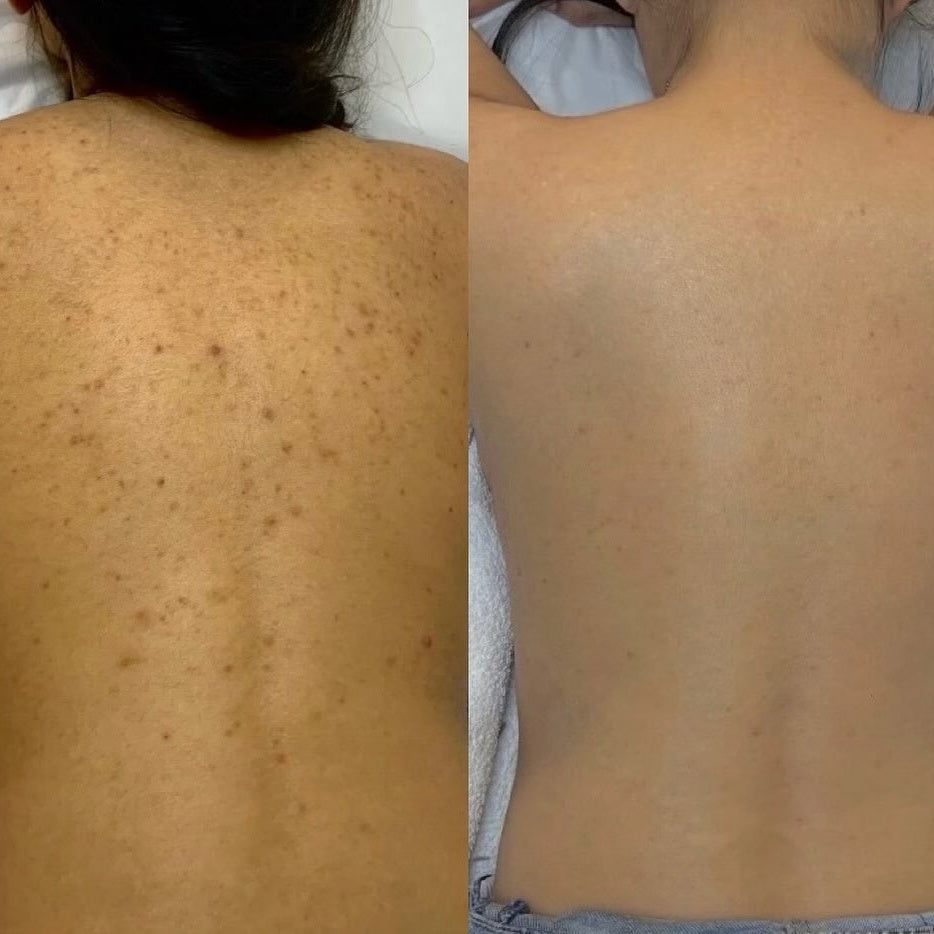 Acne Spray │ Get Rid Of Acne In Weeks