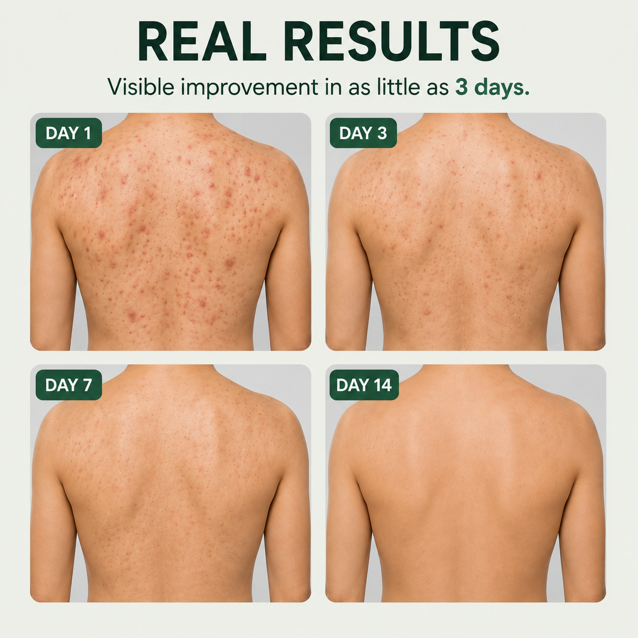 Acne Spray │ Get Rid Of Acne In Weeks