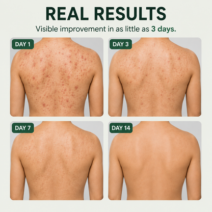 Acne Spray │ Get Rid Of Acne In Weeks