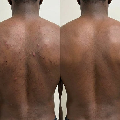 Acne Spray │ Get Rid Of Acne In Weeks